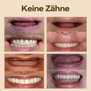 Hidone Premium Gebiss & Zahnprothese aus Silikon kaufen - Image 11