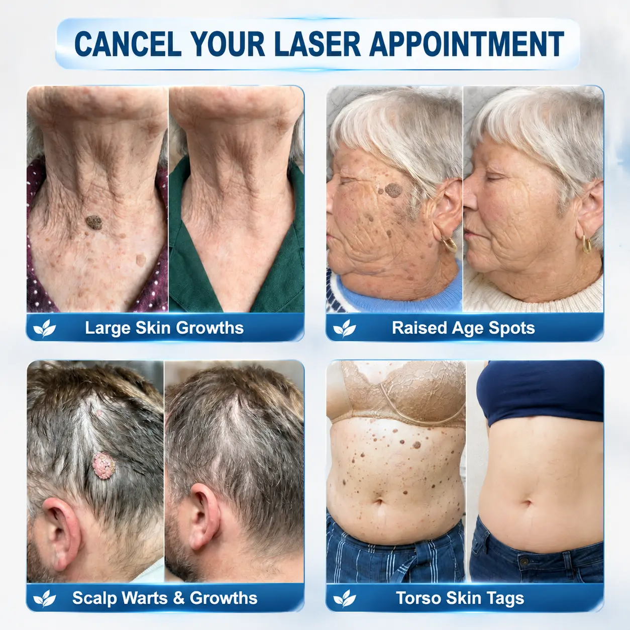 7-Day Skin Tag & Spot Eraser Painless & Scar-Free Advanced Skin Renewal Roller Pen - Image 2
