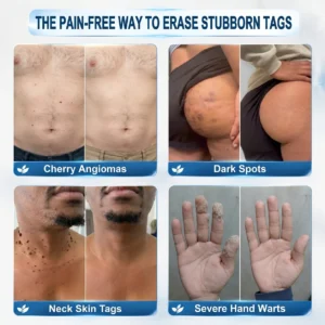 7-Day Skin Tag & Spot Eraser Painless & Scar-Free Advanced Skin Renewal Roller Pen - Image 3