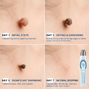 7-Day Skin Tag & Spot Eraser Painless & Scar-Free Advanced Skin Renewal Roller Pen - Image 4