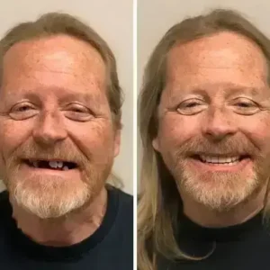 SmileFitPro BioFusion Dentures - Image 10