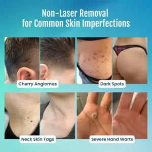 SpotlessPro Advanced Skin Care Pen - Image 9