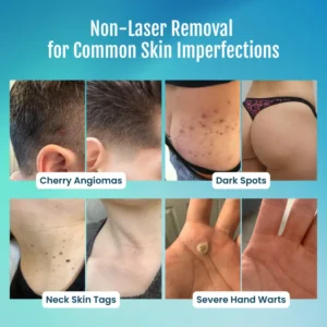 SpotlessPro Advanced Skin Care Pen - Image 3