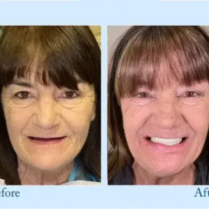 Dentures - Image 10