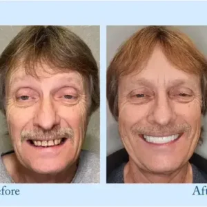 Dentures - Image 9