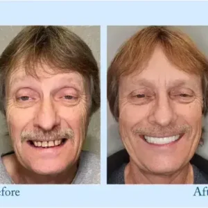 Dentures - Image 13