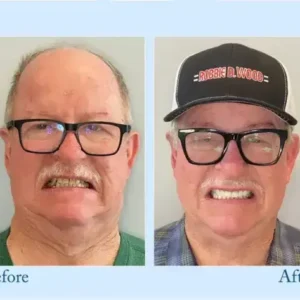 Dentures - Image 10