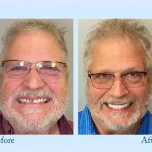 Dentures - Image 9