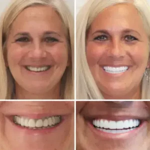 PREMIUM DENTURES - Image 3