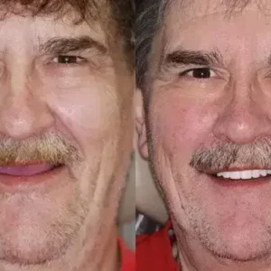 PREMIUM DENTURES - Image 11