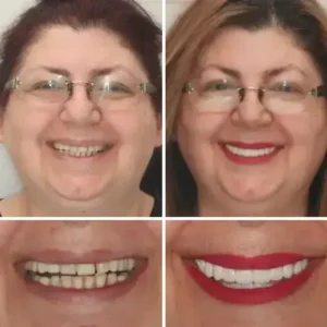 PREMIUM DENTURES - Image 2