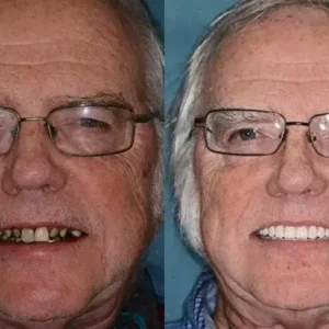 PREMIUM DENTURES - Image 11