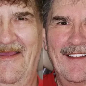 PREMIUM DENTURES - Image 12