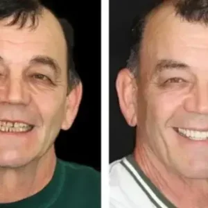 PREMIUM DENTURES - Image 12