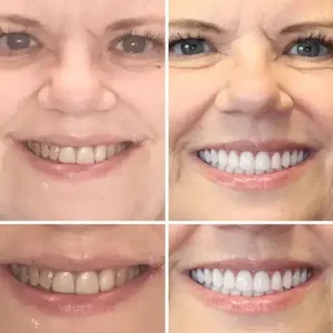 PREMIUM DENTURES - Image 4