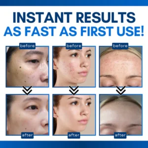 Skin Tag Treatment Pen - Image 5