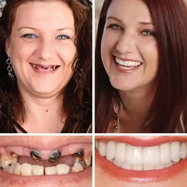 Full Denture - Image 7