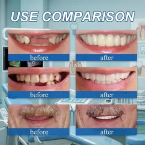 🌎Ends Today: 70% OFF! Custom-Fit Instant Smile Dentures – Natural Looking Comfort Fit - Image 4