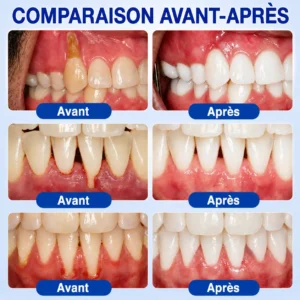 GumCare Pro : Gel Parodontal de Précision - Image 3