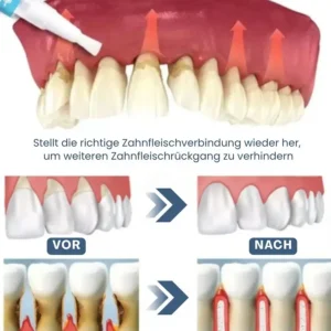 Alternative view of Zahnfleisch Sofort-Gel