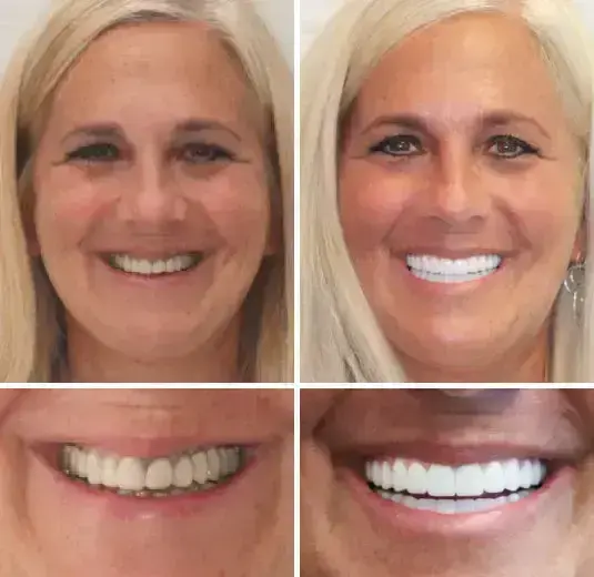 Advanced Customized Full Denture Set - Image 2