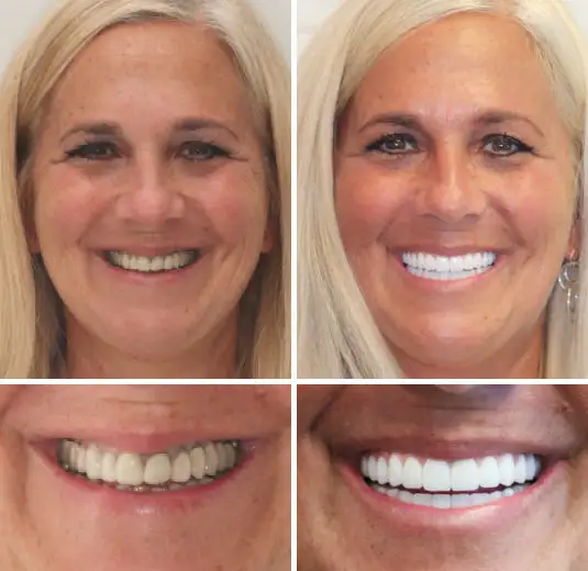 Custom-Fit Premium Dentures – Full Set - Image 5