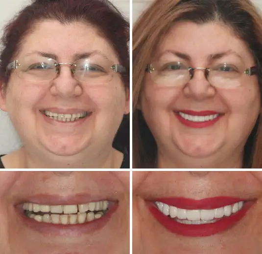 Full Denture Set🦷🦷💃Advanced Self-Adjusting Dental Materials (⏰Limited time discount last 30 minutes⏰) - Image 7