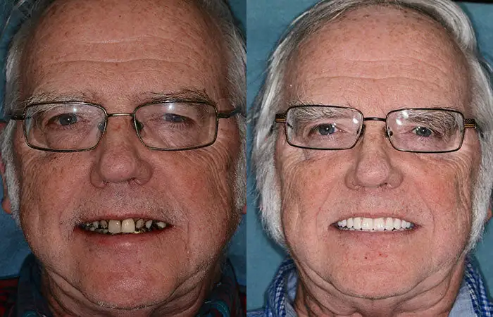 Full Denture Set🦷🦷💃Advanced Self-Adjusting Dental Materials (⏰Limited time discount last 30 minutes⏰) - Image 8