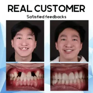Premium Custom Silicone Denture Set - Image 15