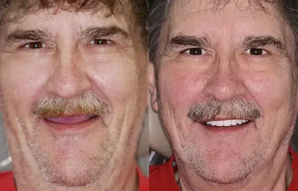 SMILE Premium Denture - Image 10