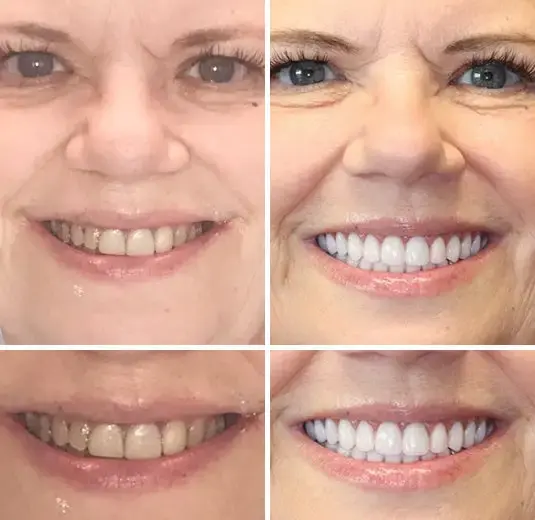 SMILE Premium Denture - Image 6