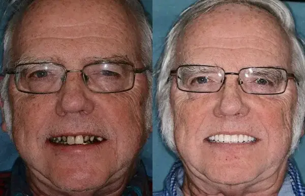 SMILE Premium Denture - Image 8
