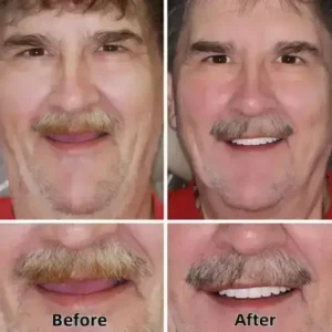 Custom Fit Dentures - Image 6