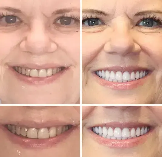 Premium Dentures - Image 8