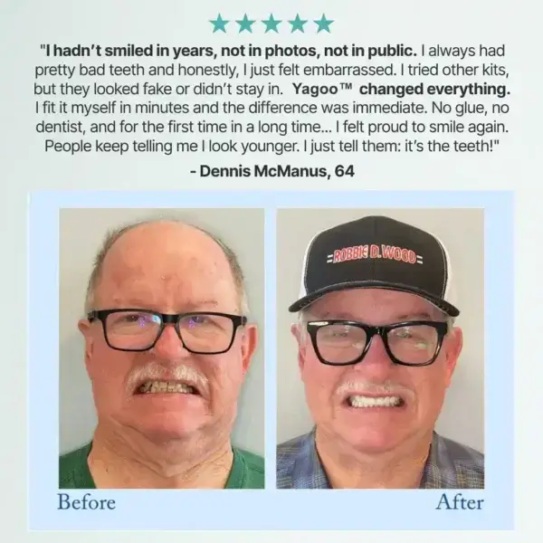 Customized Full Denture Set - Image 14